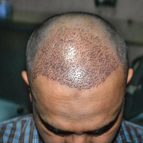 سن مناسب برای کاشت موی طبیعی