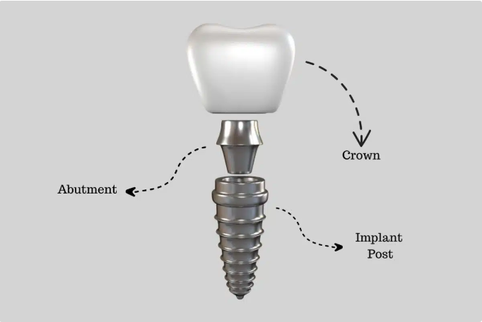 ایمپلنت دندان: بهترین راهحل برای جایگزینی دندانهای از دست رفته ایمپلنت دندان: بهترین راهحل برای جایگزینی دندانهای از دست رفته