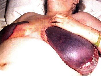 نکروز پوستی اثر جانبی وارفارین
